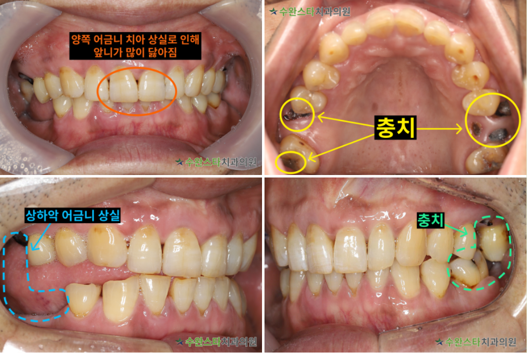 내원 시 구강 내부 사진, 50대 남성 (2025.4 촬영)