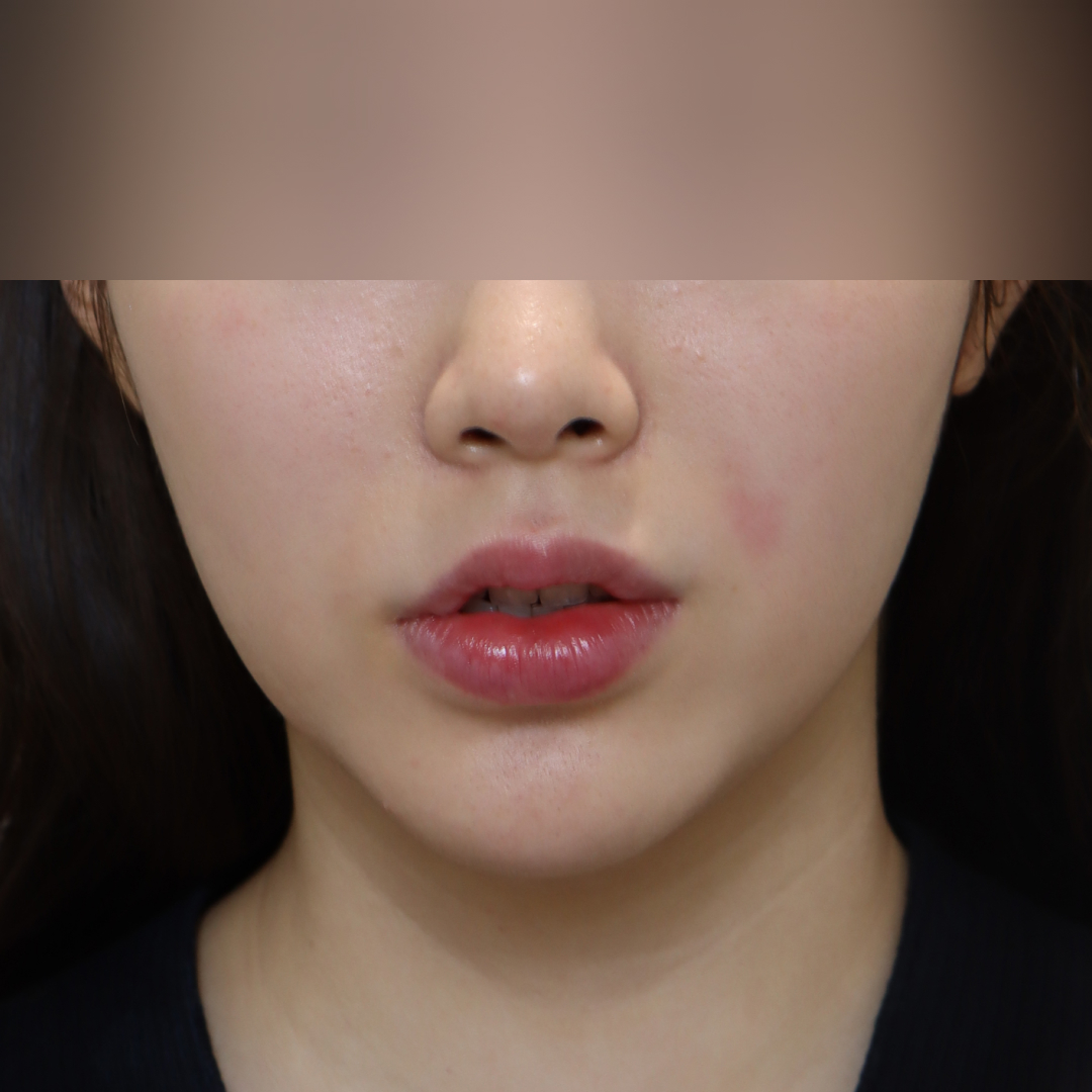 이중턱지방흡입 before정면 이미지