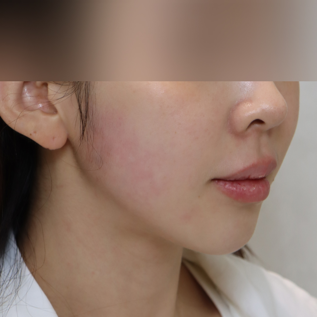 실리프팅 before측면 이미지