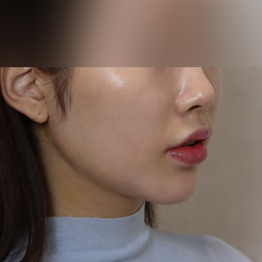 이중턱지방흡입 after측면 이미지