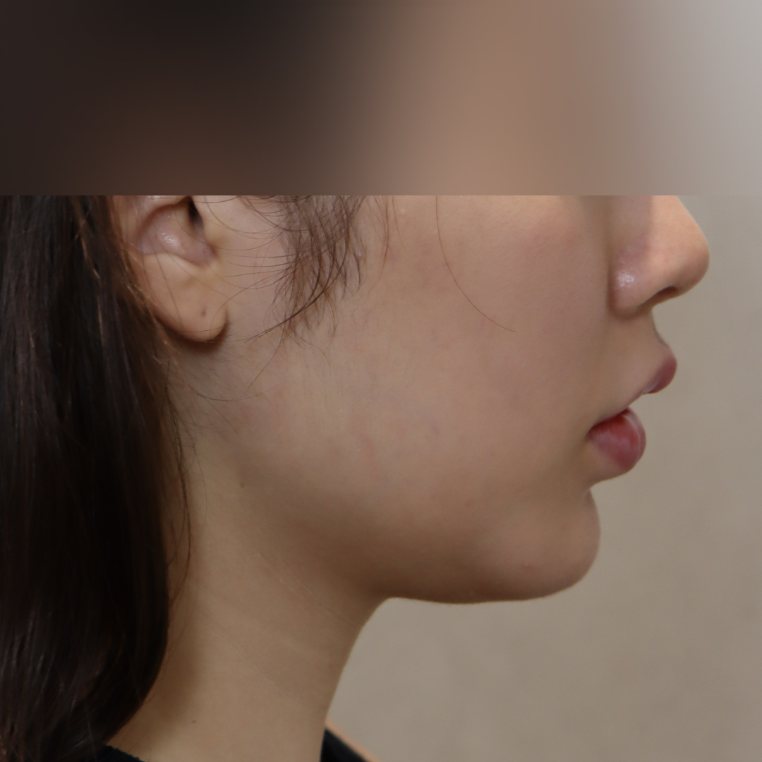 이중턱지방흡입 before 90도 이미지