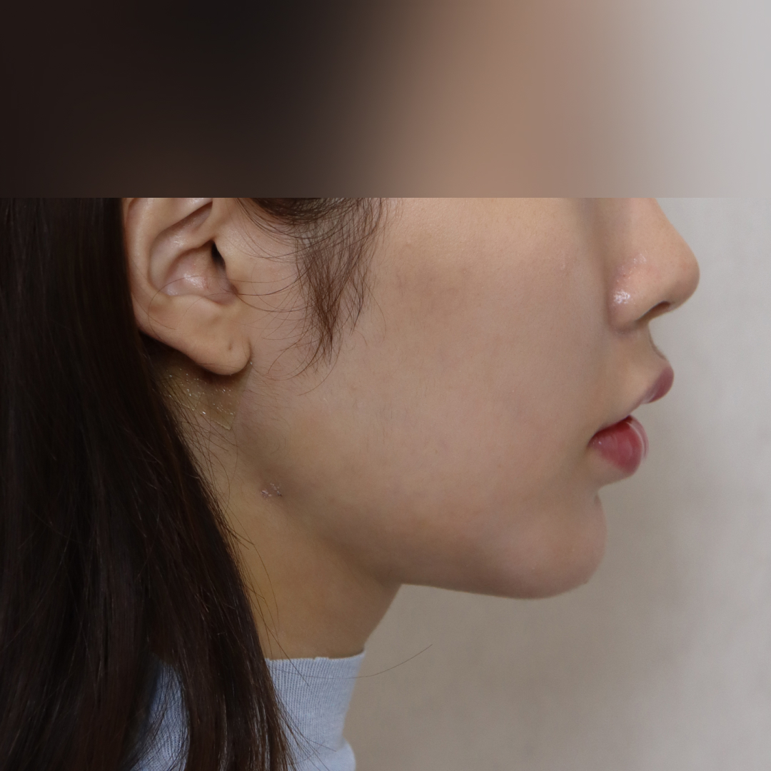 이중턱지방흡입 after 90도 이미지