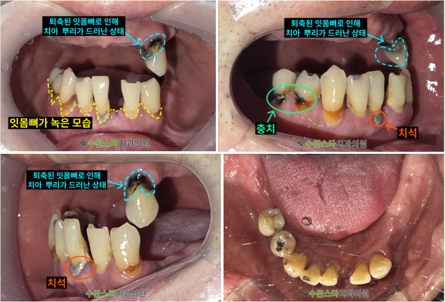 처음 내원 시 구강 내부 사진, 40대 남성 (2025.10 촬영)