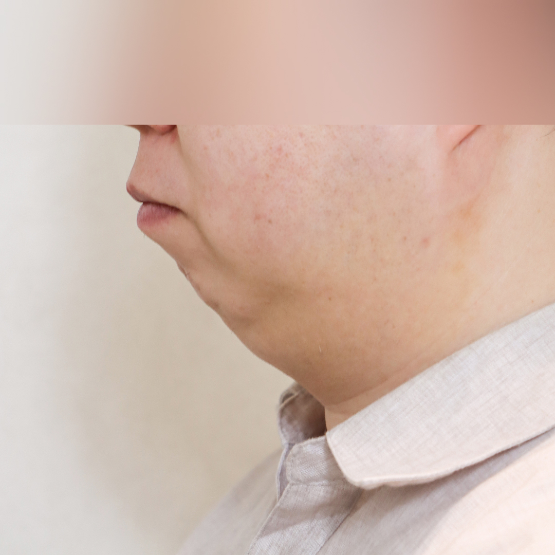 이중턱 before 90도 이미지