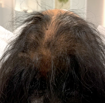 After - 5회 시술후