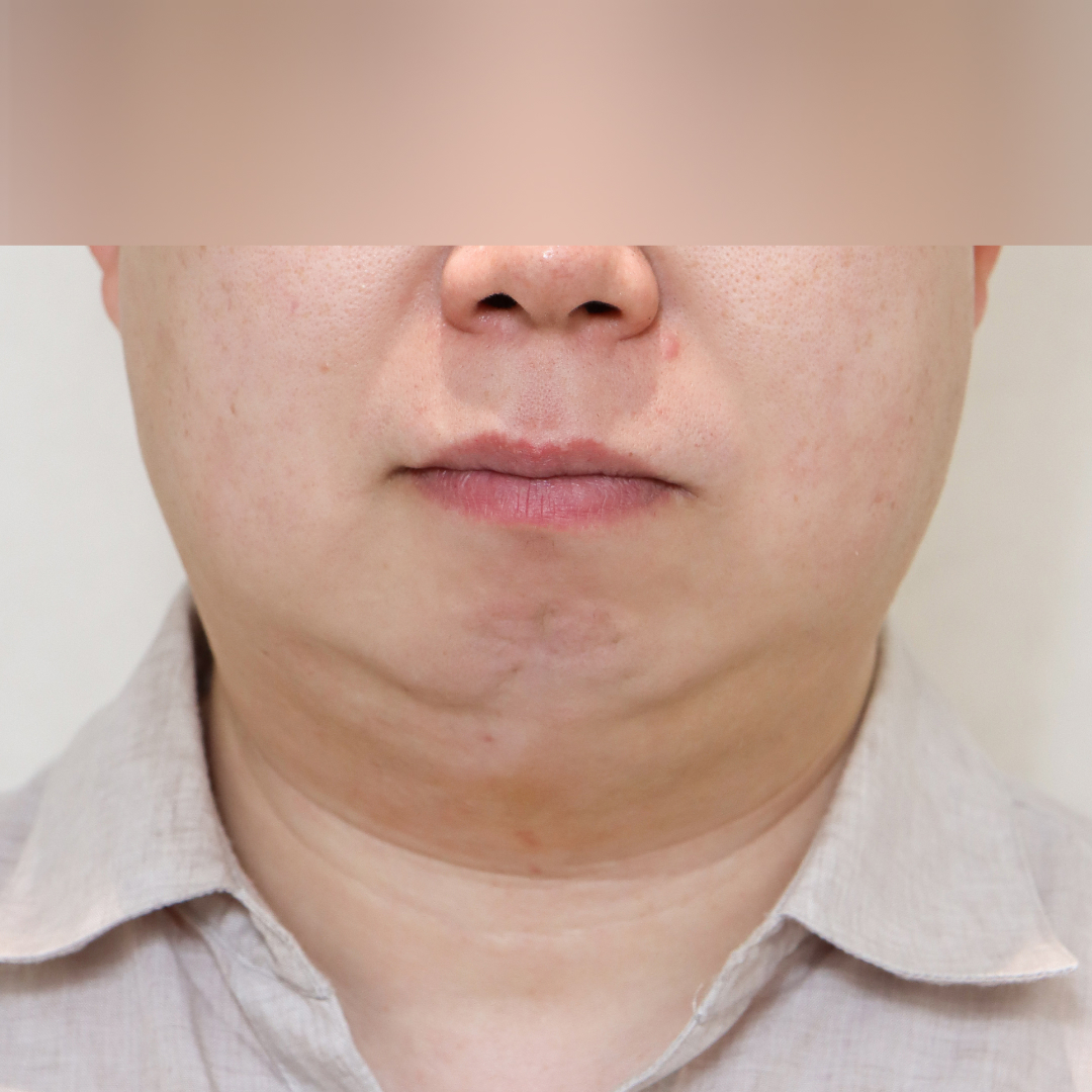 이중턱 before정면 이미지