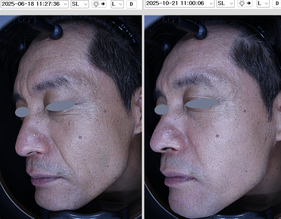 쥬브젠시술전후실제 시술하신고객님의 동의를 받았으며 별도 보정이 들어가지 않은 동일한 조건에서 촬영한 사진입니다. 해당시술은 멍, 염증, 붓기등의 부작용이 있을 수 있습니다. 