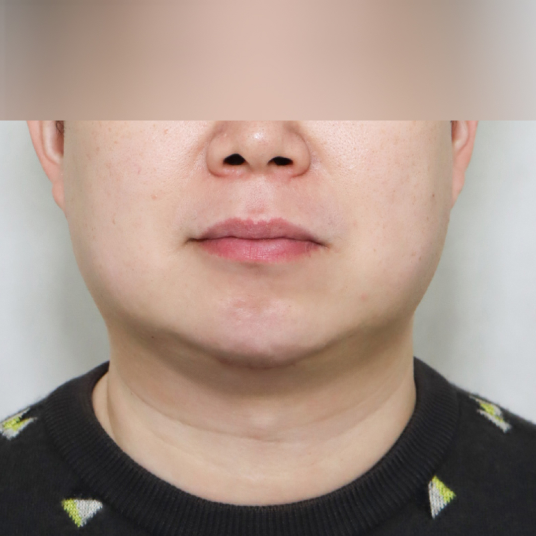 이중턱 after정면 이미지