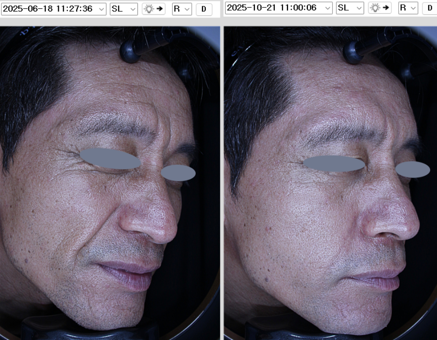 쥬브젠시술전후 실제 시술하신고객님의 동의를 받았으며 별도 보정이 들어가지 않은 동일한 조건에서 촬영한 사진입니다. 해당시술은 멍, 염증, 붓기등의 부작용이 있을 수 있습니다. 