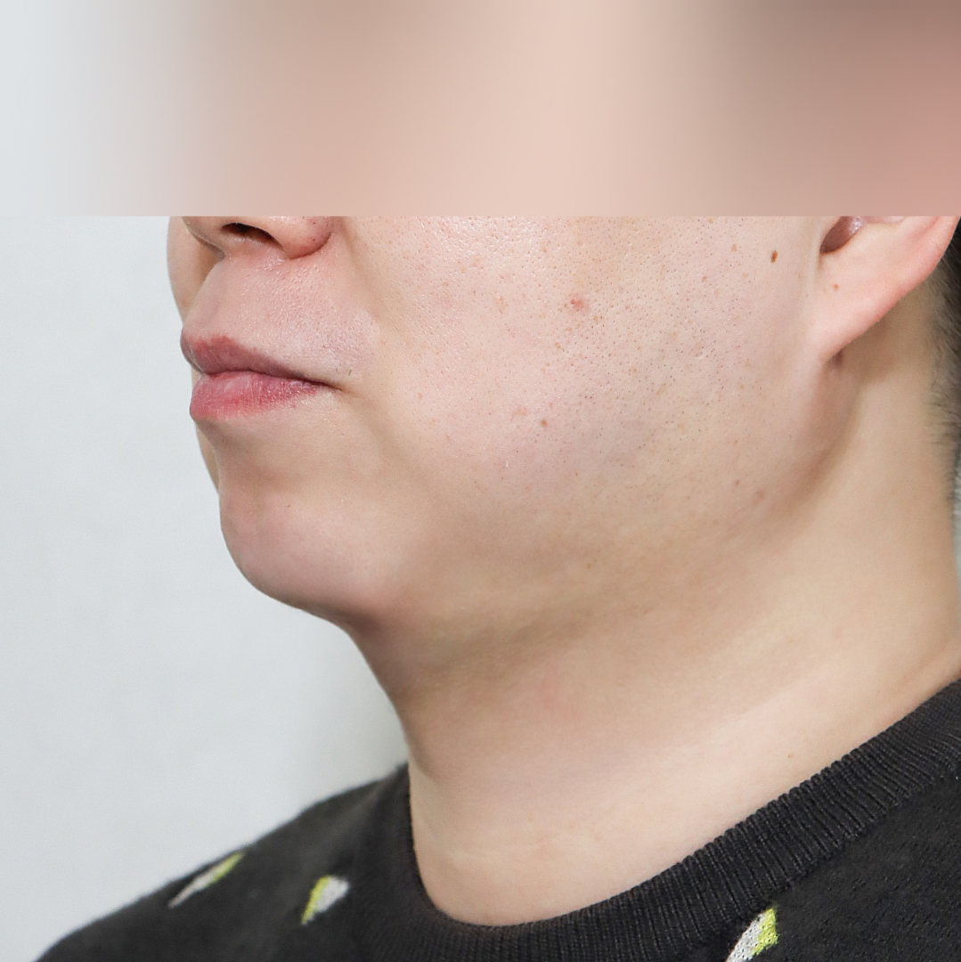 이중턱 after측면 이미지