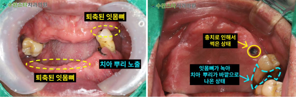처음 내원 시 구강 내부 사진, 60대 남성 (2025.2 촬영)