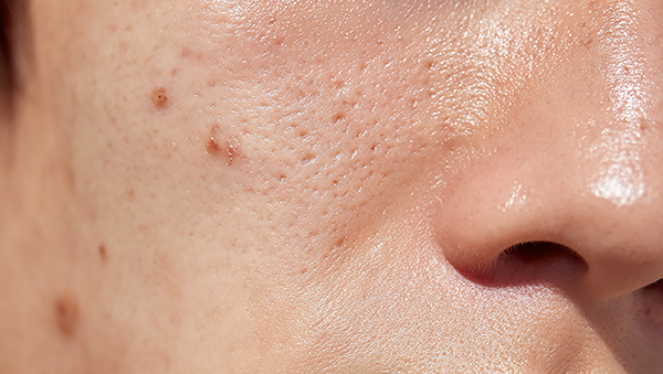 튼살을 찍은 사진