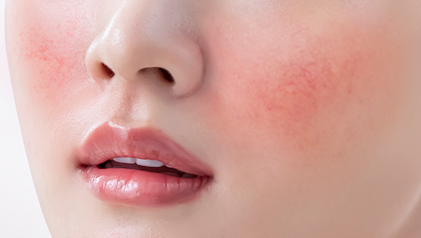 얼굴에 트러블이 심하게 생긴 모습