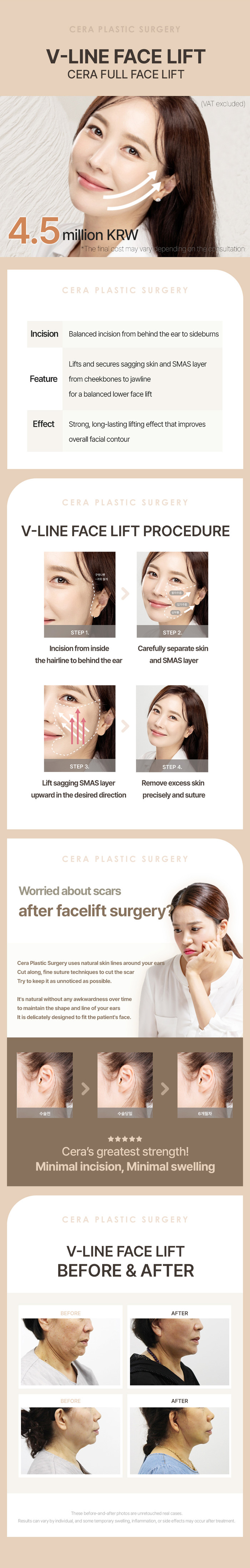 세라성형외과 눈코 재수술 전문