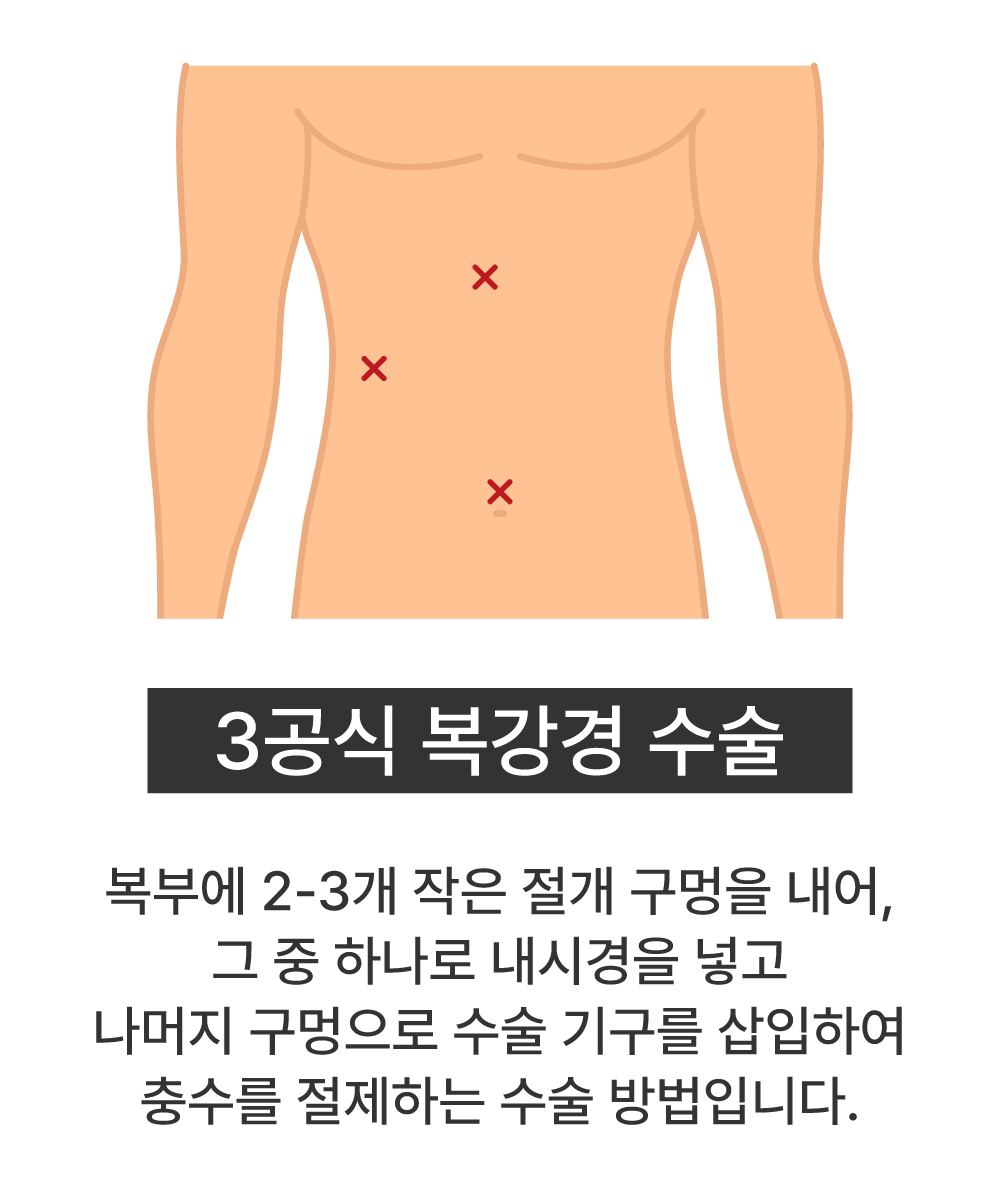 3공식 복강경 수술
