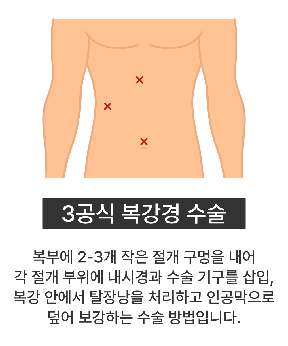 3공식 복강경 수술