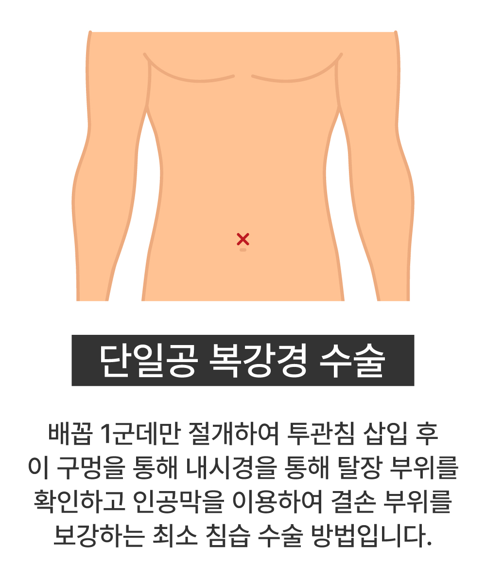 단일공 복강경 수술