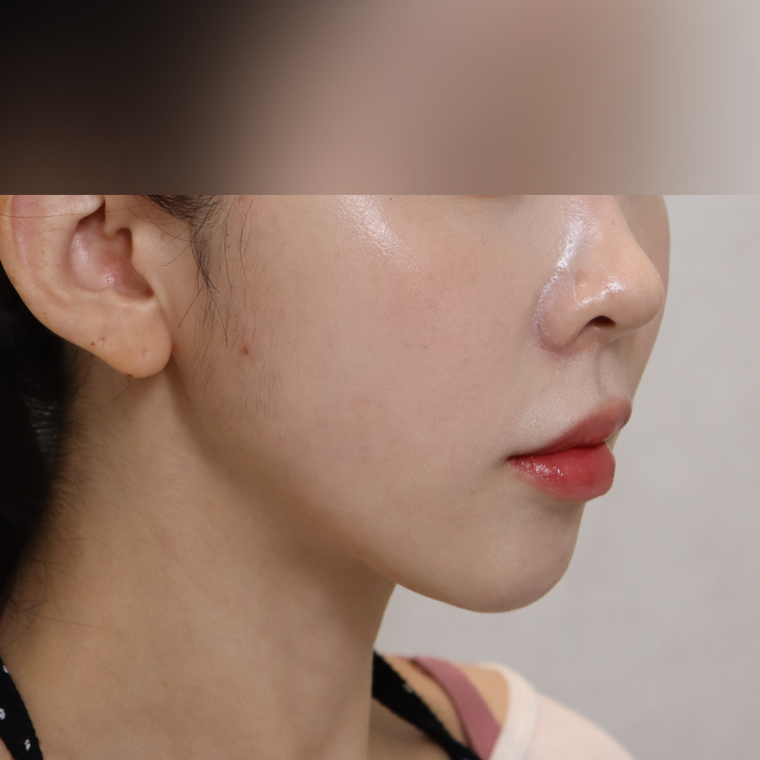 실리프팅 after측면 이미지