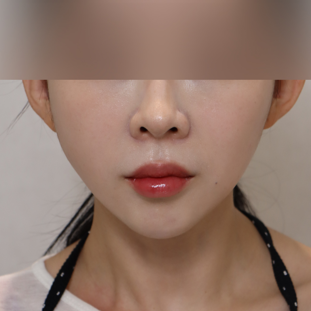 실리프팅 after정면 이미지