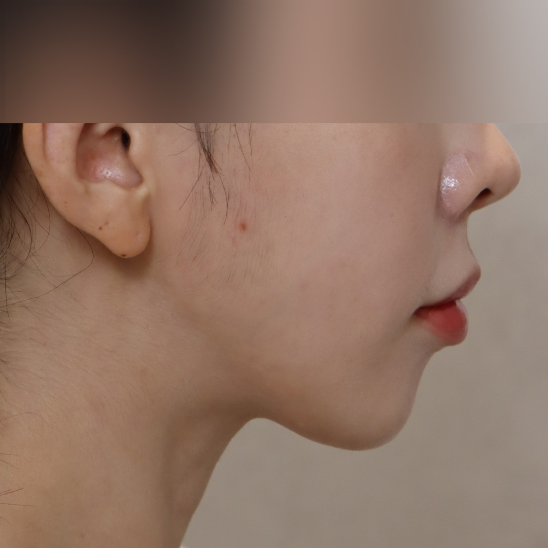 실리프팅 after 90도 이미지