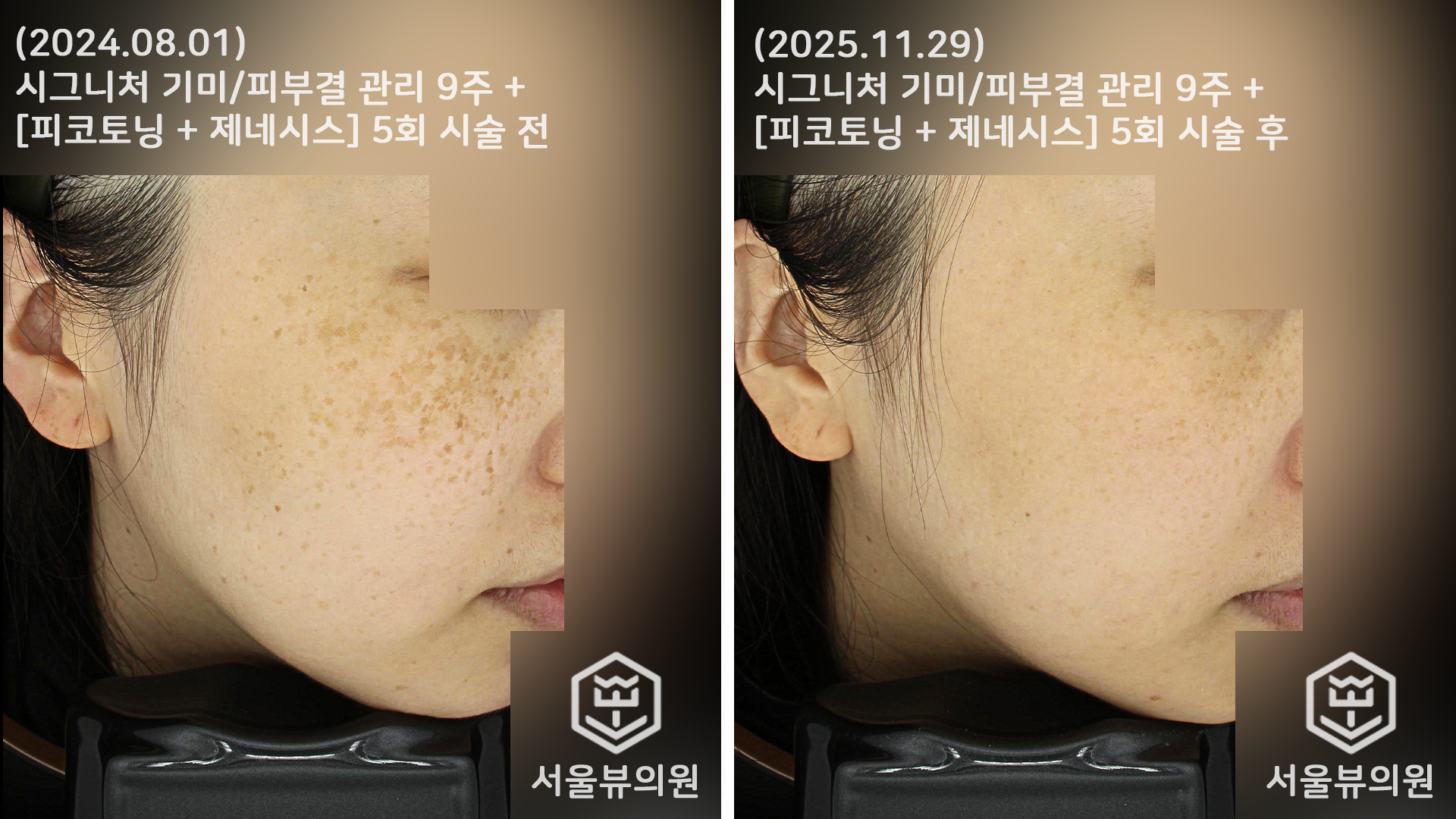 대전유성피부과 서울뷰의원 색소치료 전후사진: 기미, 잡티 등 다양한 고민 해결
