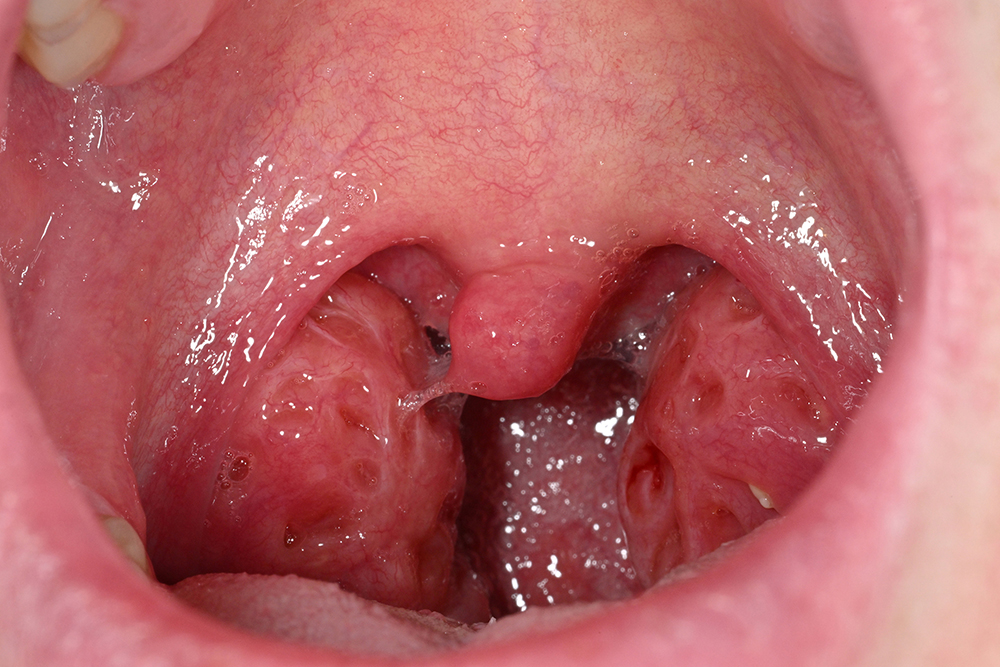 편도 및 아데노이드 절제술