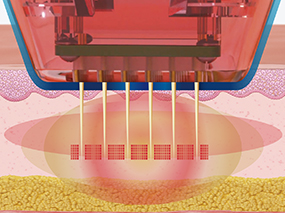 3. 고주파 에너지 전달 응고존 형성