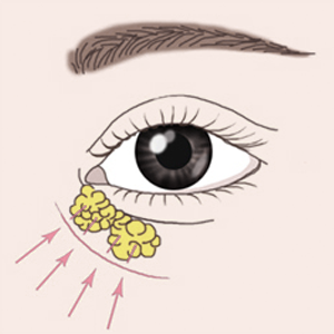 피부 재배치 앞트임