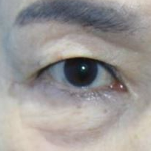 피부 재배치 앞트임