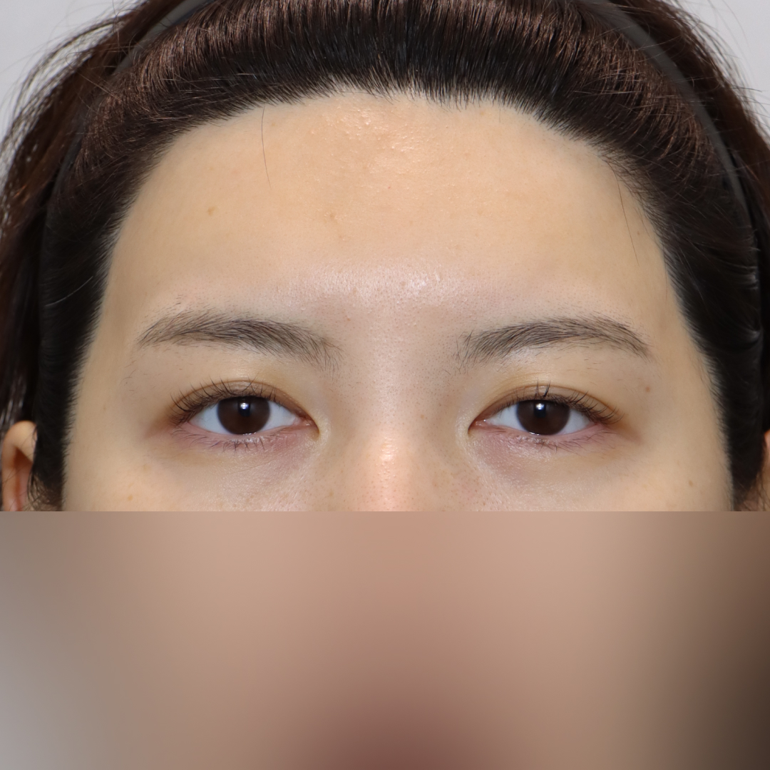 실리프팅 Before 정면