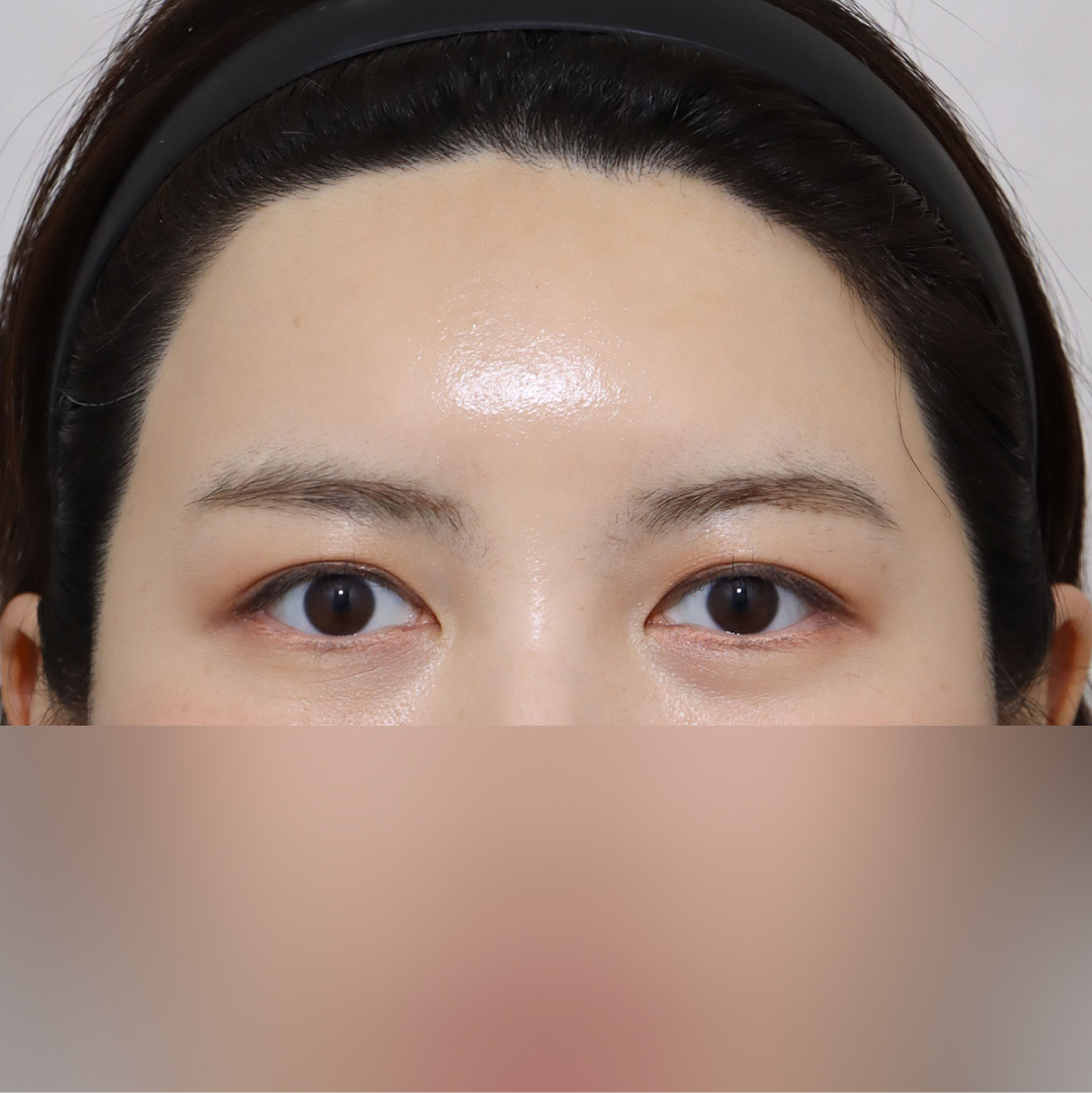 실리프팅 After 정면