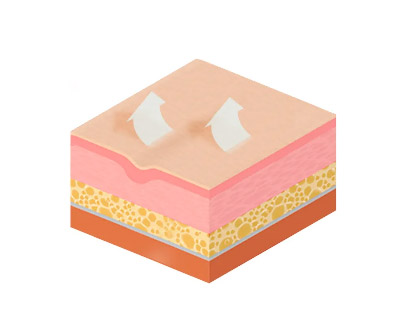 Deep wrinkles caused by aging. SMAS_Retaining Ligament_Epidermis Dermis Subcutaneous Fat Muscle Periosteum