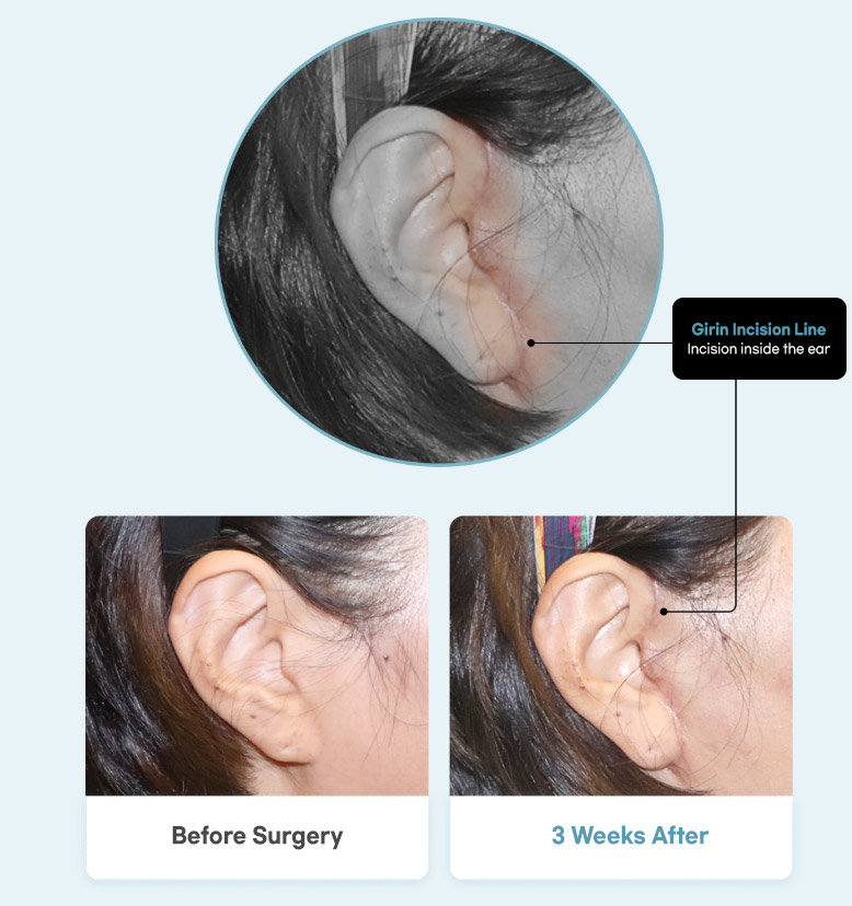 Girin Incision Line  Incision inside the ear