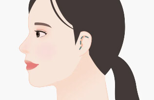Minimized scars with incisions inside the ear