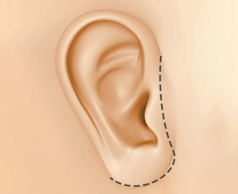 Facelift_Standard Incision