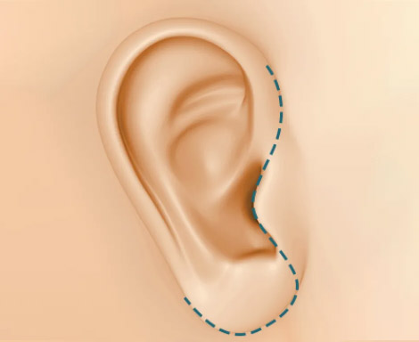 Facelift_Girin Incision