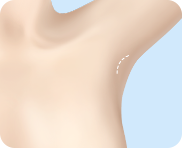 Underarm Incision (Transaxillary Incision)