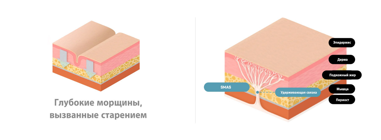 Глубокие морщины, вызванные старением Эпидермис Дерма Подкожный жир Мышца Периост