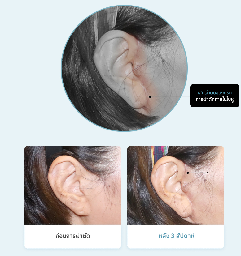 เส้นผ่าตัดของกิรินการผ่าตัดภายในใบหู