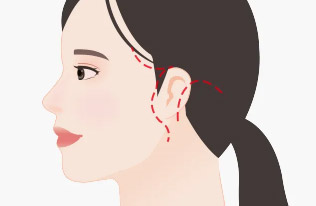 รอยแผลเป็นยาวเนื่องจากการผ่าตัดที่มีขอบเขตการผ่าตัดกว้าง