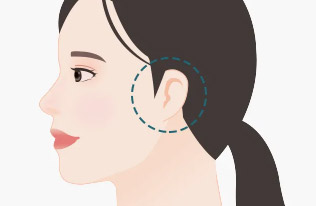 การรักษารูปร่างของหูให้คงที่หลังการผ่าตัด