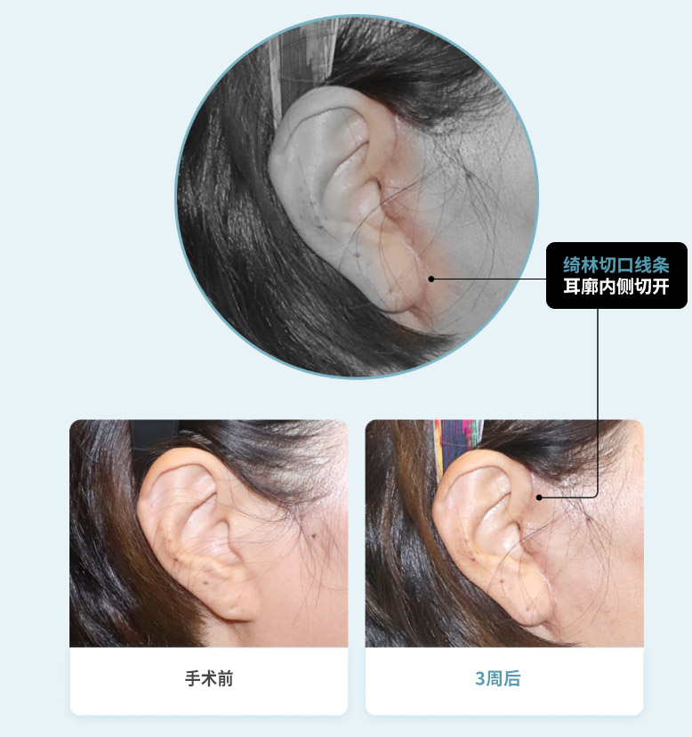 绮林切口线条耳廓内侧切开