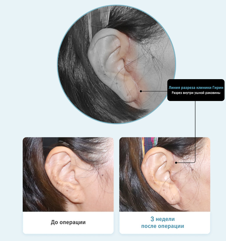 Линия разреза клиники Гирин  Разрез внутри ушной раковины