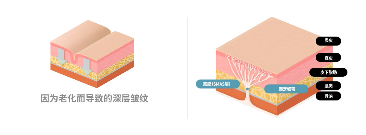 仅拉紧皮肤的提升方式  效果维持不久，也无法改善皮下脂肪或肌肉层的松弛