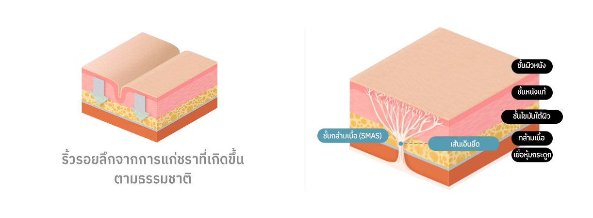 ริ้วรอยลึกจากการแก่ชราที่เกิดขึ้นตามธรรมชาติ