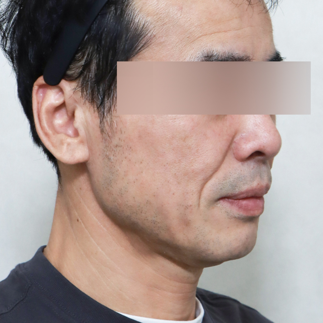 안면거상술 before측면 이미지