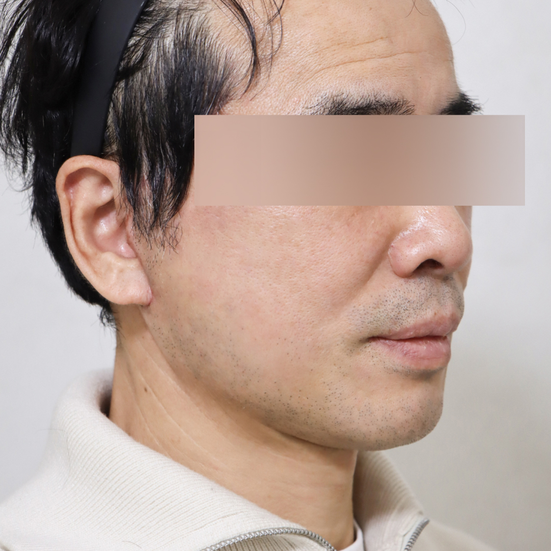 안면거상술 after측면 이미지