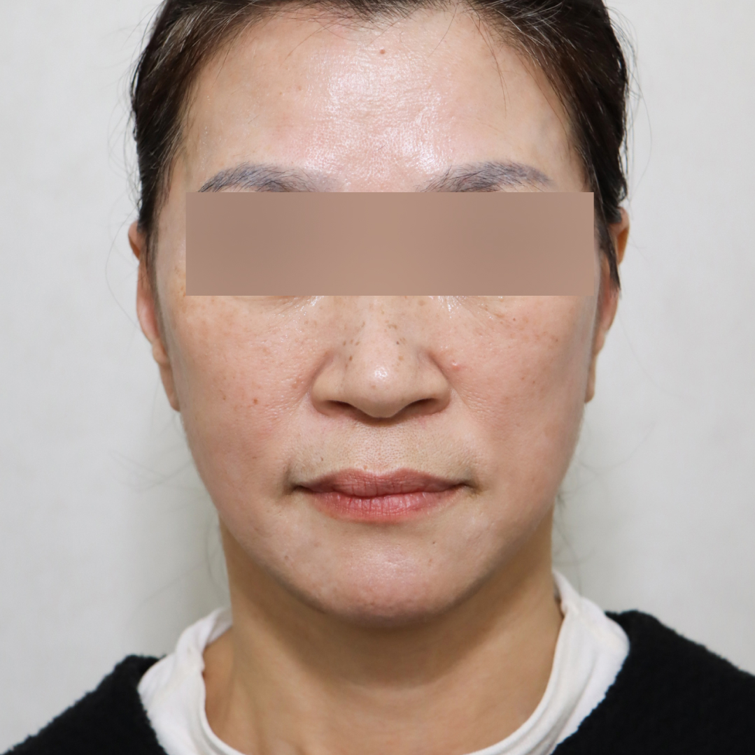 안면거상술 after정면 이미지