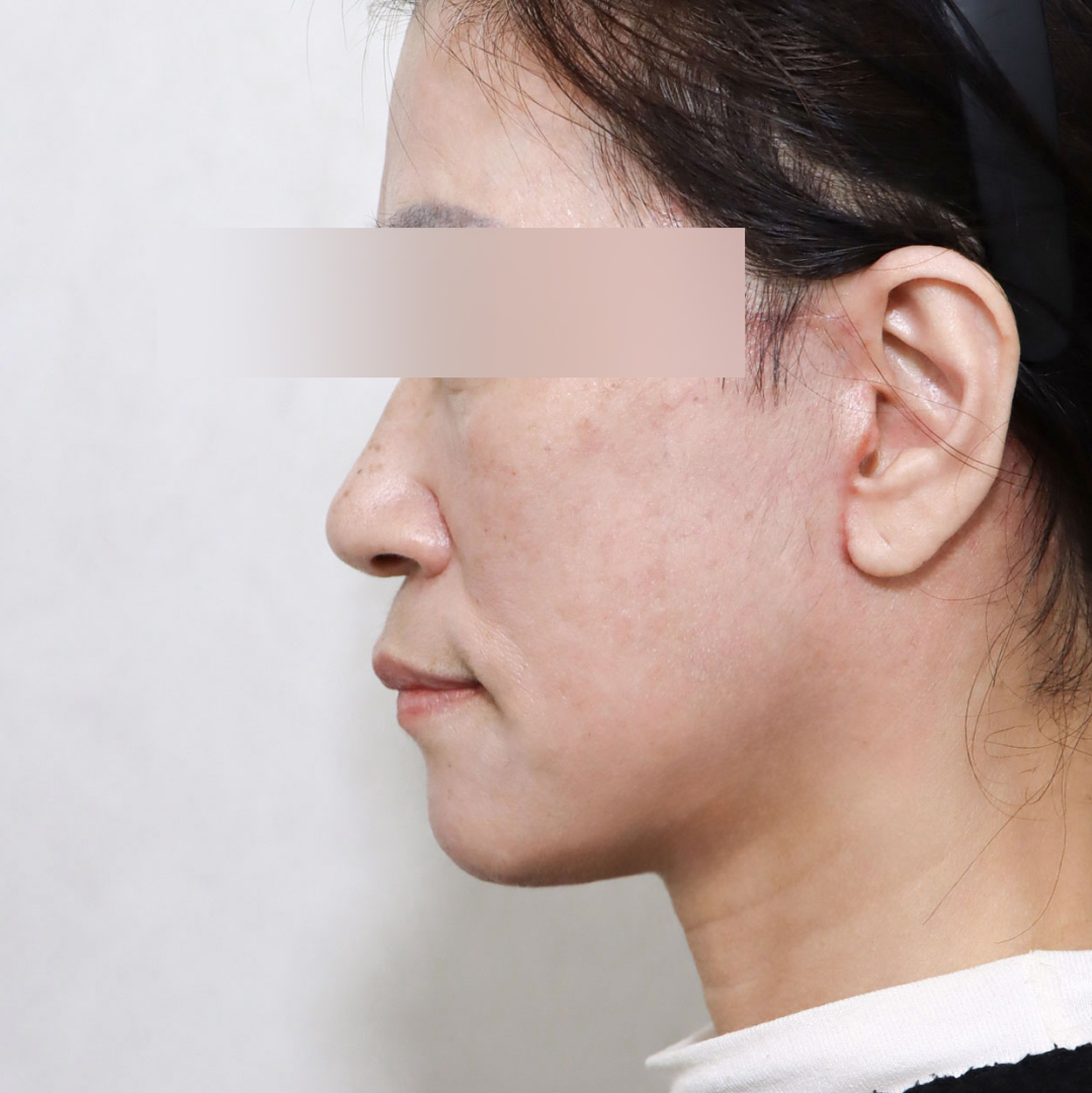 안면거상술 after 90도 이미지