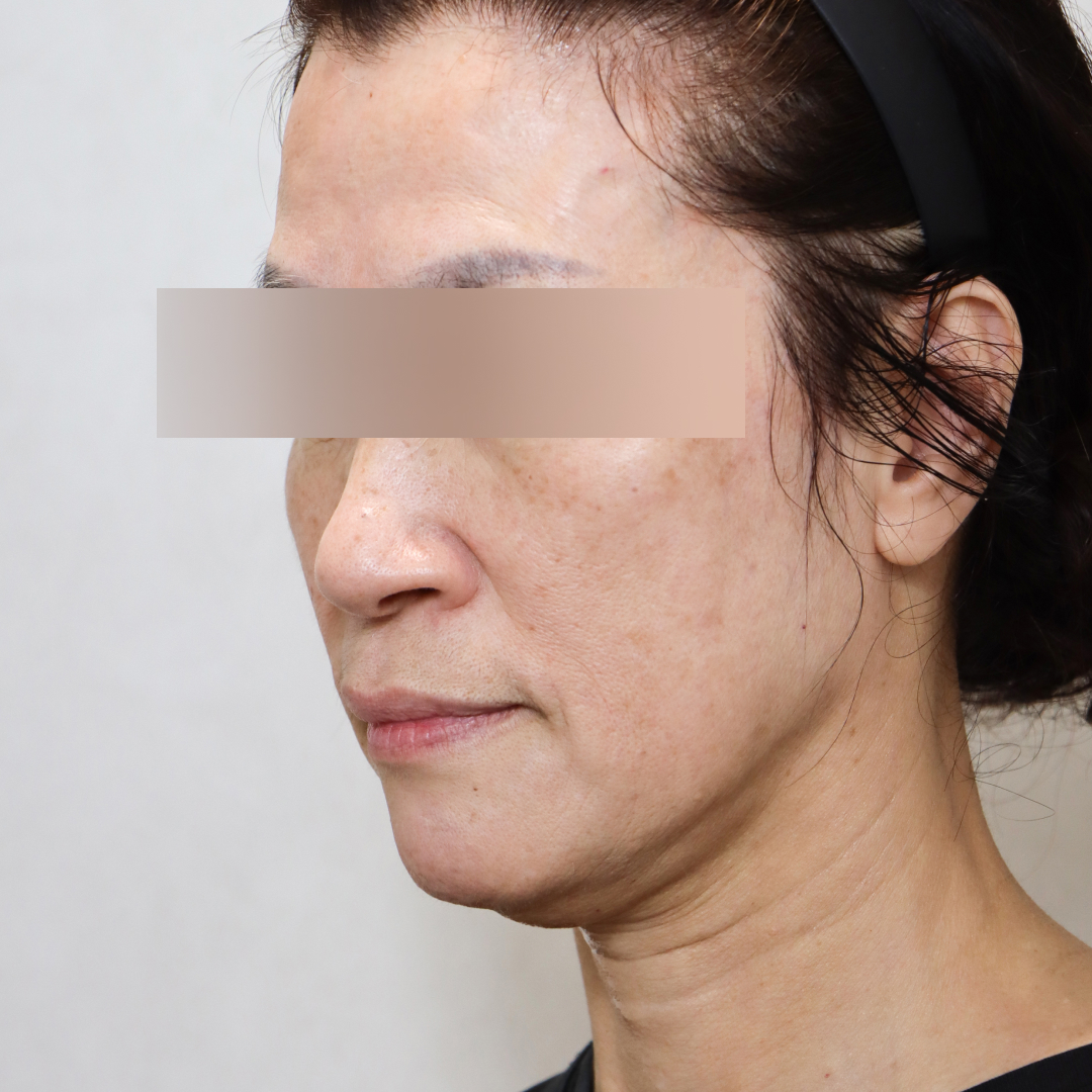 안면거상술 before측면 이미지